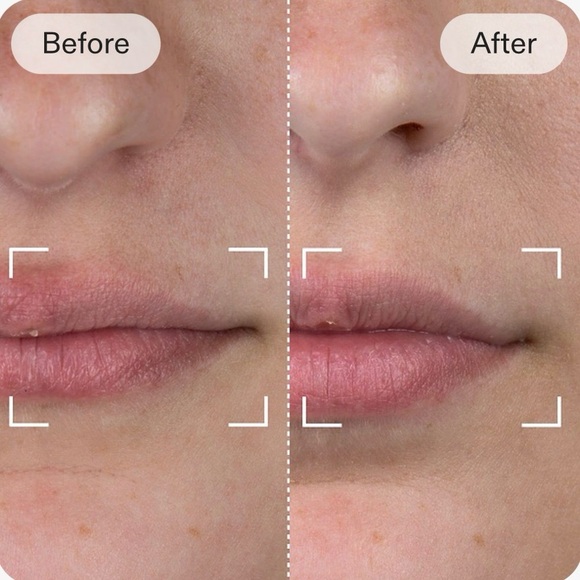 CURRENTBODY skin LED Lip Perfector Anti-aging LED wearable for youthful lips*NWB - Picture 5 of 6